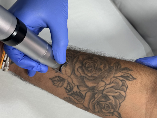 Détatouage laser  - Iris Pi 