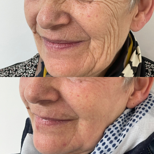 Peeling profond Exopeel